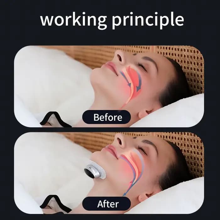 Dispositif anti-ronflement avec stimulation à double impulsion – Soulagement de l'apnée du sommeil