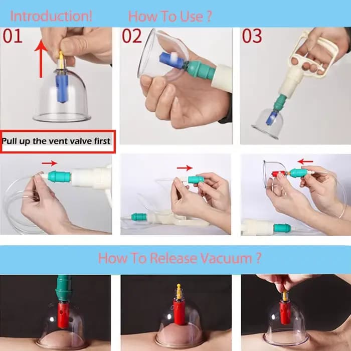 Ensemble de thérapie par ventouses médecine chinoise physiothérapie